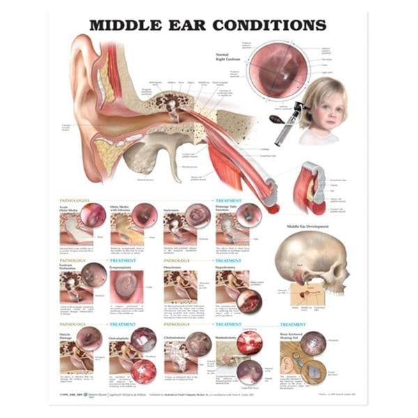 Middle Ear Conditions 20x26" Anatomical Chart Ea