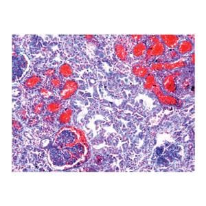 Diseased Human Tissue Educational Slide Set 15/St