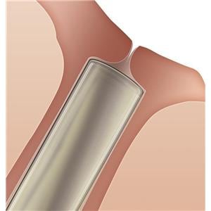 Soft Plug Plug Collagen 0.4x2mm 60/Bx