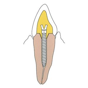 Surtex Posts Stainless Steel Refill Sz 1.5 mm Parallel Sided & Tapered End 12/Bx