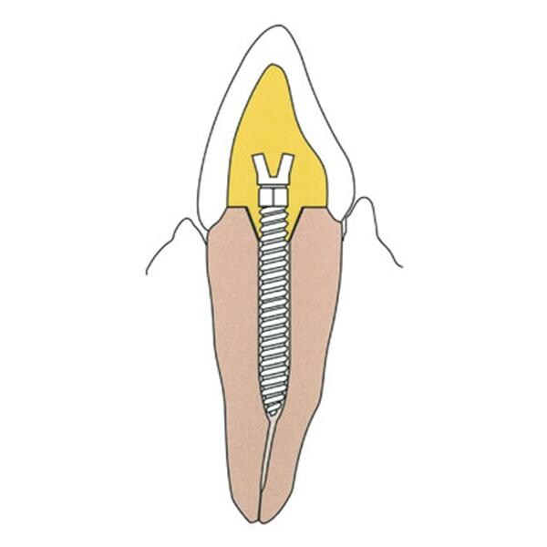 Surtex Posts Stainless Steel Refill Sz 1.5 mm Parallel Sided & Tapered End 12/Bx
