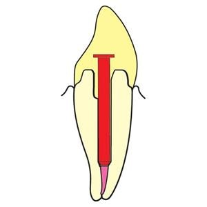 ParaPost XP Temporary Posts Titanium 5 0.05 in Red 20/Pk